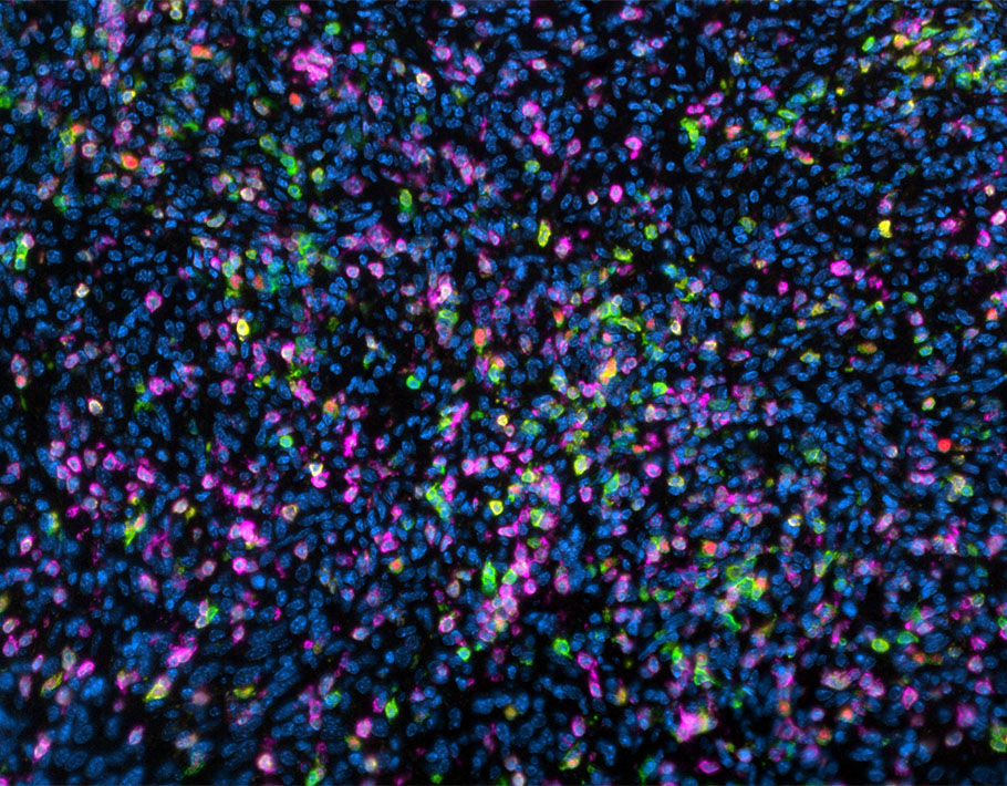 Science Magazine (@sciencemagazine) on Twitter photo A genetic signature can help scientists identify patients with nonhypermutated #cancer who may benefit from checkpoint blockade #immunotherapy, according to a new <a href="/ScienceTM/">Science Translational Medicine</a> analysis of 12 groups of patients with common tumors. fcld.ly/mexoo8j A genetic signature can help scientists identify patients with nonhypermutated #cancer who may benefit from checkpoint blockade #immunotherapy, according to a new <a href="/ScienceTM/">Science Translational Medicine</a> analysis of 12 groups of patients with common tumors. fcld.ly/mexoo8j