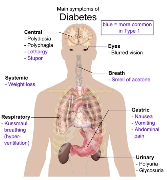 CheckDontGuess's tweet photo. Please take a min and learn about the seriousness of Diabetes and how you can prevent certain death if ignored. Diabetic Ketoacidosis can and will kill you don't ignore the early warning signs. #DiabetesAwareness #DKA #Ketones #DFDA https://t.co/WPp2H8UQCl
