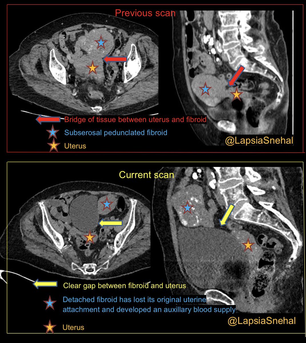LapsiaSnehal's tweet photo. When a child leaves home !  Always check previous before describing a “new” mass. Thanks to @MaiD44774166 for sharing. #FOAMrad #FOAMed #meded #obygyn #frcr #MedStudentTwitter #radtwitter #radres #futureradres #surgery #gynae #gyn #anatomy #radiology #fibroid https://t.co/638yholKhc