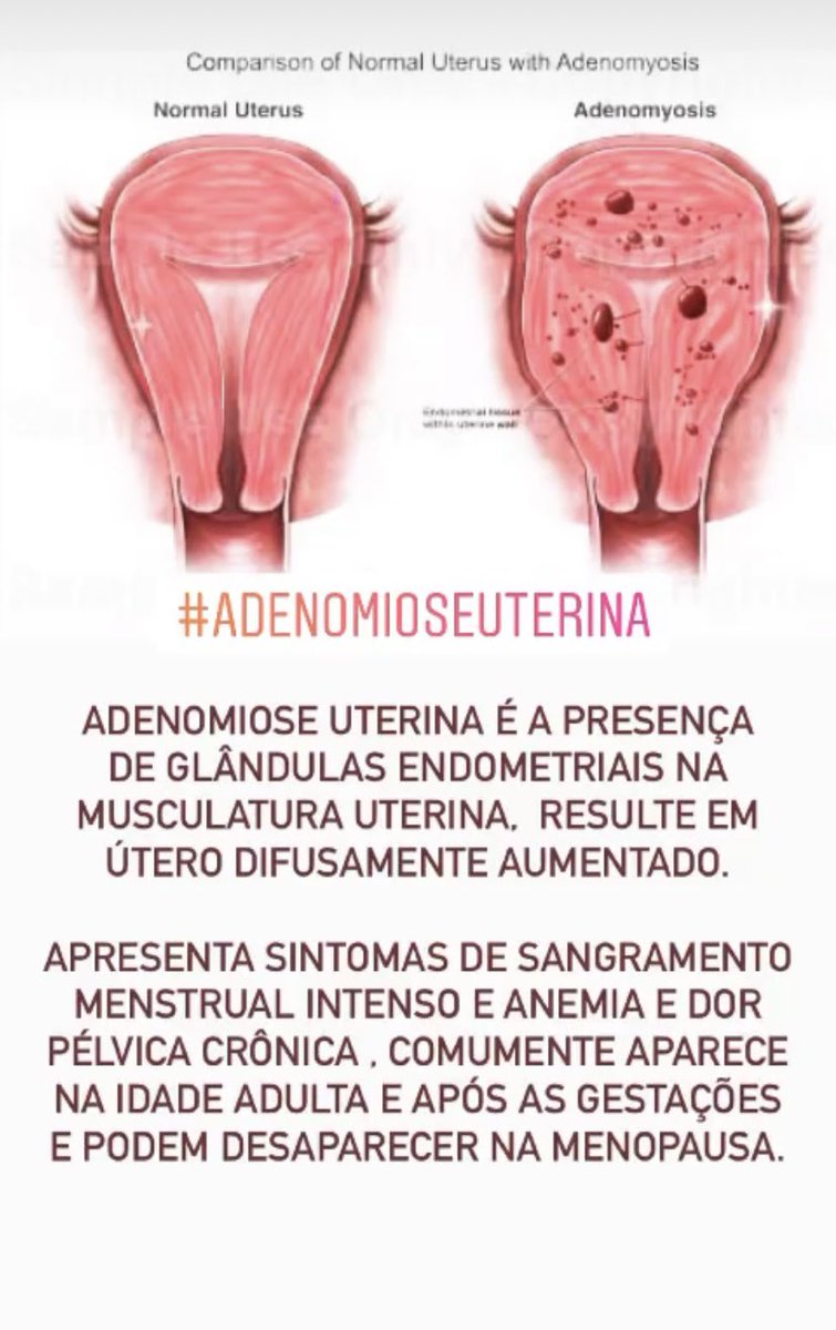 Adenomiose