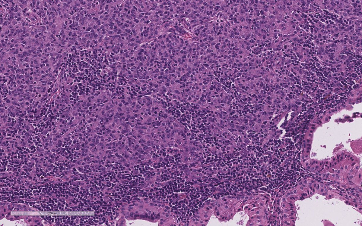 WeinrebIlan's tweet photo. Another Warthin tumour with a stowaway…

Since it came up in my previous tweet last week…

Here is an actual acinic cell carcinoma inside a Warthin tumour! https://t.co/zraHSBsfgG