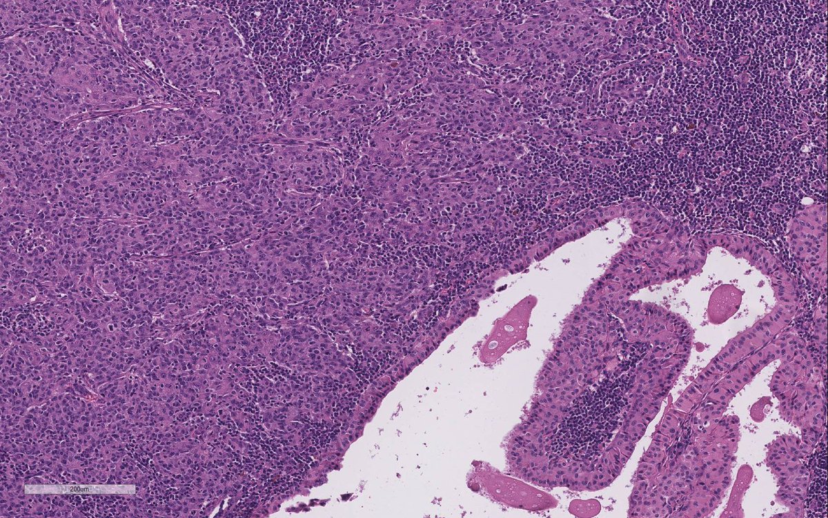 WeinrebIlan's tweet photo. Another Warthin tumour with a stowaway…

Since it came up in my previous tweet last week…

Here is an actual acinic cell carcinoma inside a Warthin tumour! https://t.co/zraHSBsfgG