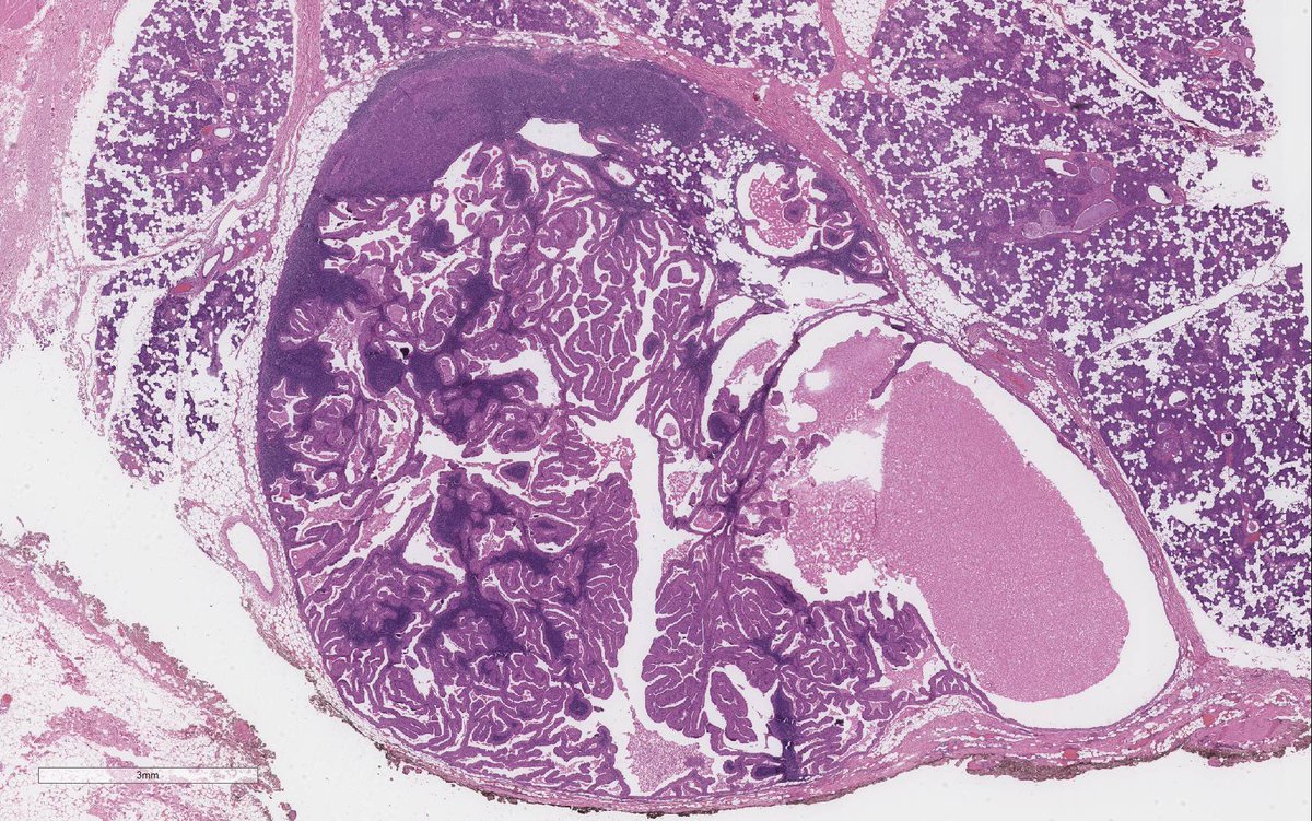 WeinrebIlan's tweet photo. Another Warthin tumour with a stowaway…

Since it came up in my previous tweet last week…

Here is an actual acinic cell carcinoma inside a Warthin tumour! https://t.co/zraHSBsfgG