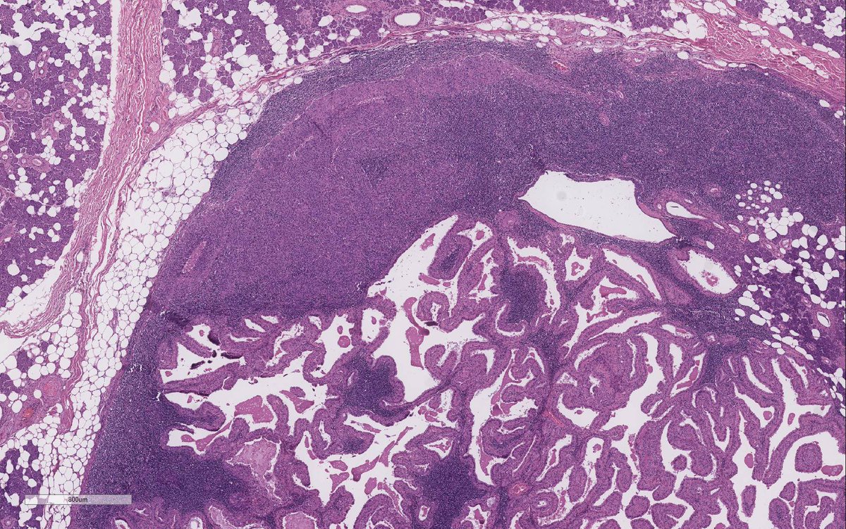 WeinrebIlan's tweet photo. Another Warthin tumour with a stowaway…

Since it came up in my previous tweet last week…

Here is an actual acinic cell carcinoma inside a Warthin tumour! https://t.co/zraHSBsfgG