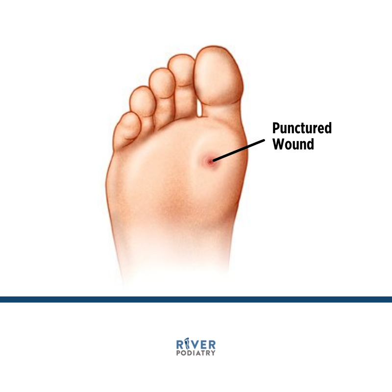 River_Podiatry's tweet photo. Click the link below to learn more about what you should do about punctured wounds. 

https://t.co/5tM2BUjGCA https://t.co/wNDj9ljmUr