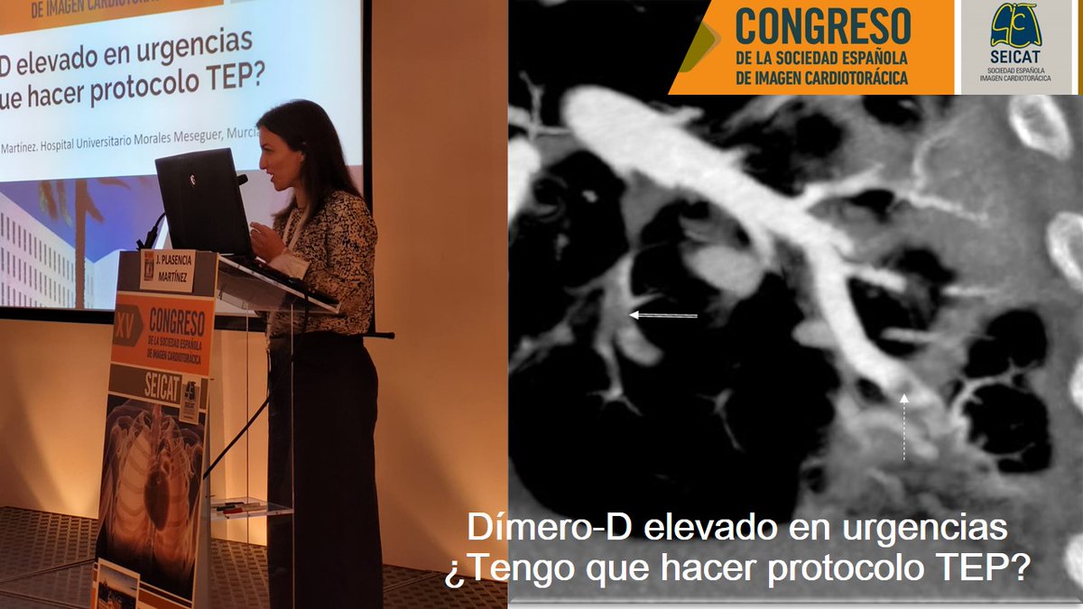 serammeA6SALUD's tweet photo. J. Plasencia @JuanaPlasen @serammeA6SALUD en su ponencia @SEICAT_RAD la semana pasada abordó el problema diagnóstico de la tromboembolia pulmonar. Muchos más estudios de imagen con muchos menos diagnósticos no es una buena idea. El algoritmo YEARS puede ser muy útil para mejorar. https://t.co/NgU84jpem3