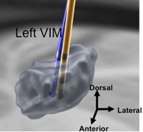 MichaelOkun's tweet photo. Spoiler alert; if you have Deep Brain Stimulation your brain will atrophy over time which is normal; however the lead positions will shift relative to the anatomy. Make sure your teams know how to manage a moving target.https://t.co/rv21Rzoip3 @DBSThinkTank @leaddbs https://t.co/lO4eDZAqOb