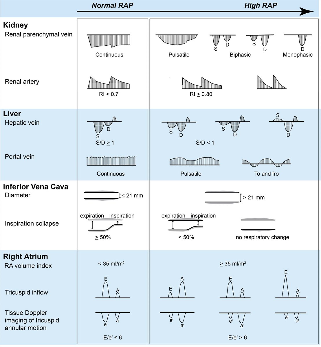 The original infographic depicting #POCUS #echofirst patterns across the spectrum of right atrial pressure (RAP). This was before publication of #VExUS score.
From 2016 editorial in JACC Heart Fail. pubmed.ncbi.nlm.nih.gov/27395345/
#MedEd #Nephrology