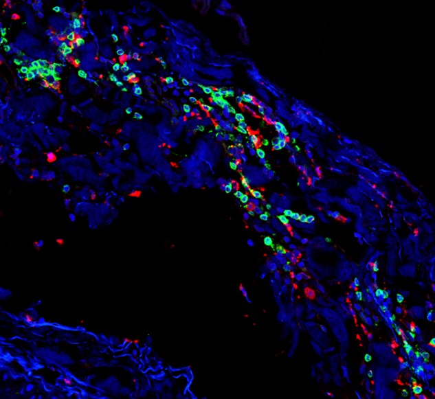 The December cover image is from "B Cell–Activating Factor Antagonism Attenuates the Growth of Experimental Abdominal Aortic Aneurysm", authors at <a href="/UVACVRC/">UVA CVRC</a>  (<a href="/UVA/">UVA</a>) and <a href="/EastCarolina/">ECU</a>.

Full text: ajp.amjpathol.org/article/S0002-…