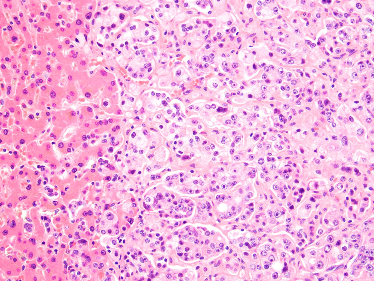 drmehrarohit's tweet photo. Metastatic #ProstateCancer in liver #GUPath #Cancers @PCF_Science @UMichPath https://t.co/qbRXZpBMqQ