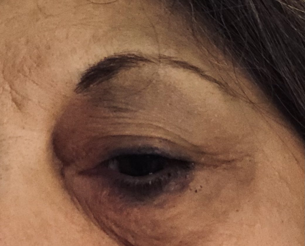 Smwslife's tweet photo. @ThatEricAlper 3rd time walking into an X-ray tube!#xraylife
This happened this morning!
3rd black eye in the works! https://t.co/HiXGTHgxOC