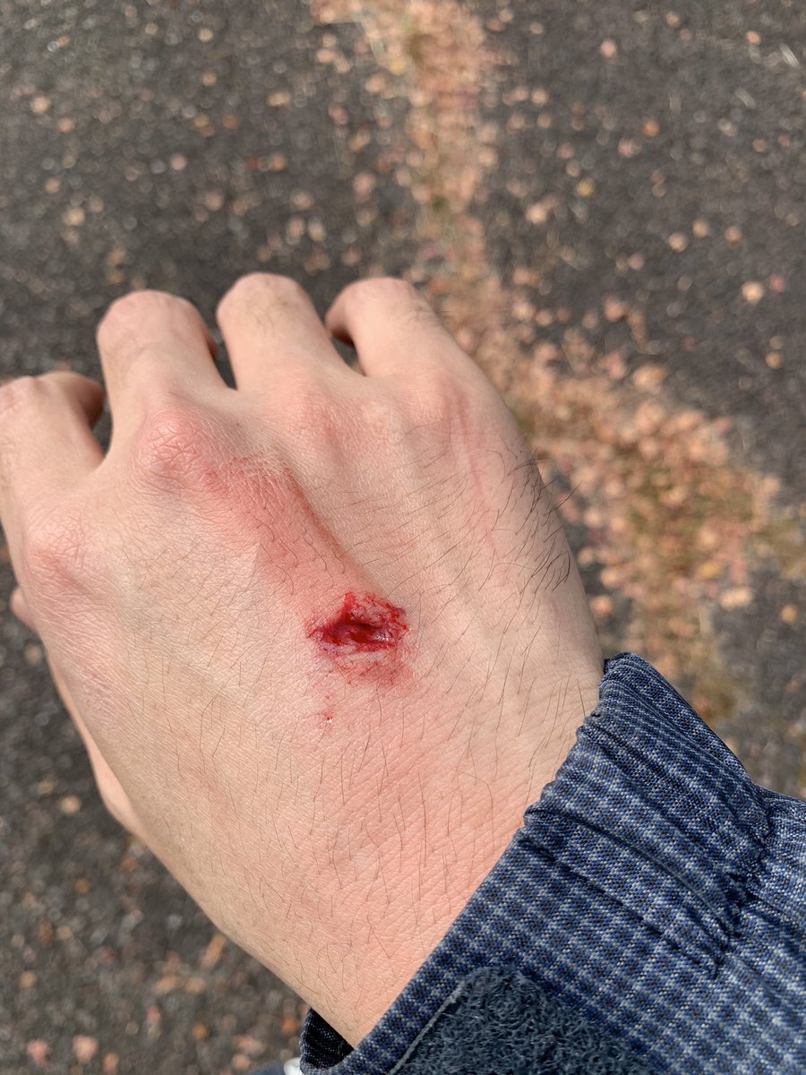 yoshiichi66's tweet photo. 剣山スーパー林道でツーリング中、でかめの落石により負傷！
レントゲンで異常無かったけど、力入れたら骨折系の痛みが😱
傷が治るまで器械出しも禁止です(T . T) https://t.co/okFA3oqcCk