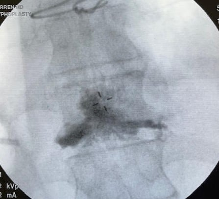 ApolloPainMan's tweet photo. We performed a #kyphoplasty with excellent spread along the region of his fracture. He walked out pain free!
#Compressionfractures can occur from seemingly innocuous events (like picking up a suitcase). The stearable system from @Merit_Spine can access both sides of the vertebra. https://t.co/hmeBgeMC1J
