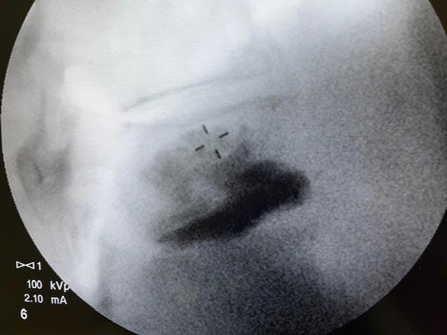 ApolloPainMan's tweet photo. We performed a #kyphoplasty with excellent spread along the region of his fracture. He walked out pain free!
#Compressionfractures can occur from seemingly innocuous events (like picking up a suitcase). The stearable system from @Merit_Spine can access both sides of the vertebra. https://t.co/hmeBgeMC1J
