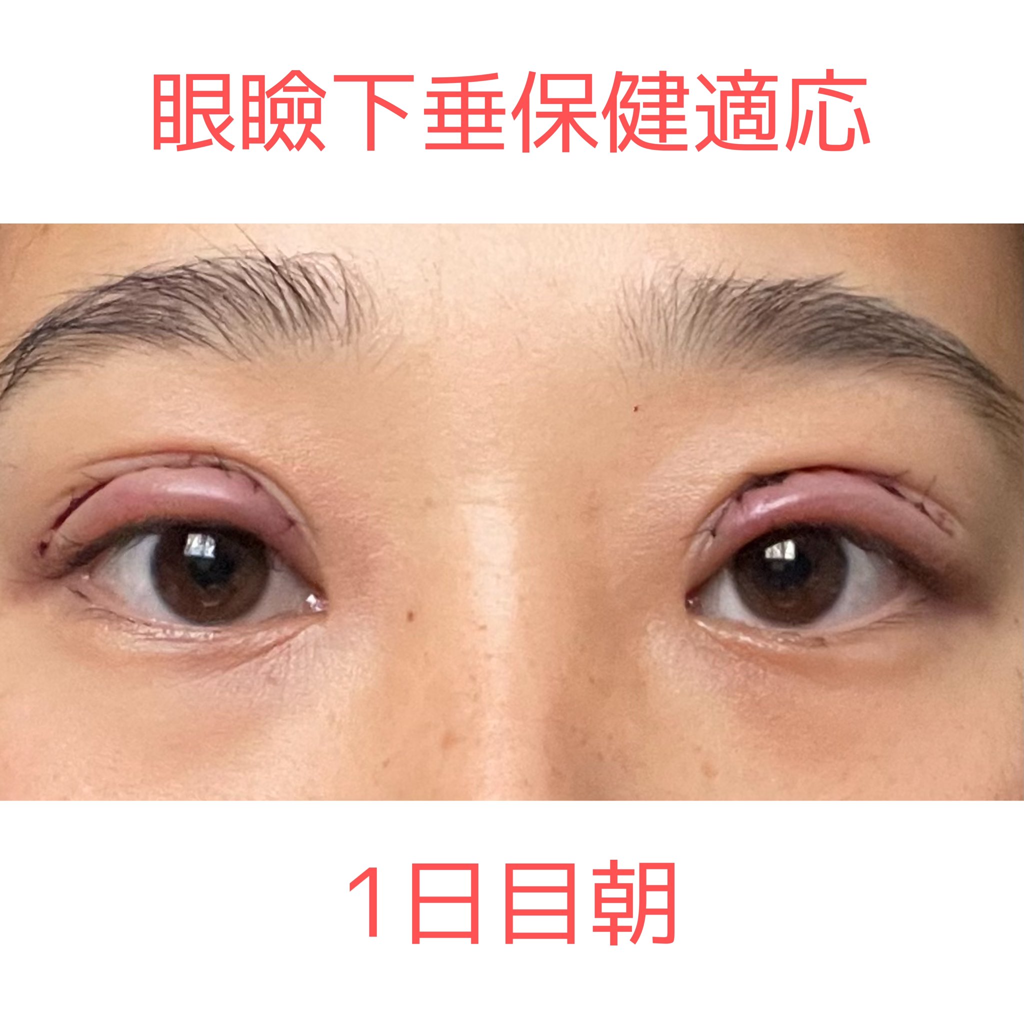 麦茶 眼瞼下垂保健適応dt0日目 17時からの手術で 4時間ほど経った状態です 幅広めの末広二重 希望してたけど 先生との意思疎通がうまくいかなくて幅狭めになってしまった 奥二重にならないといいな 経過はツリーにぶら下げていきます 眼瞼