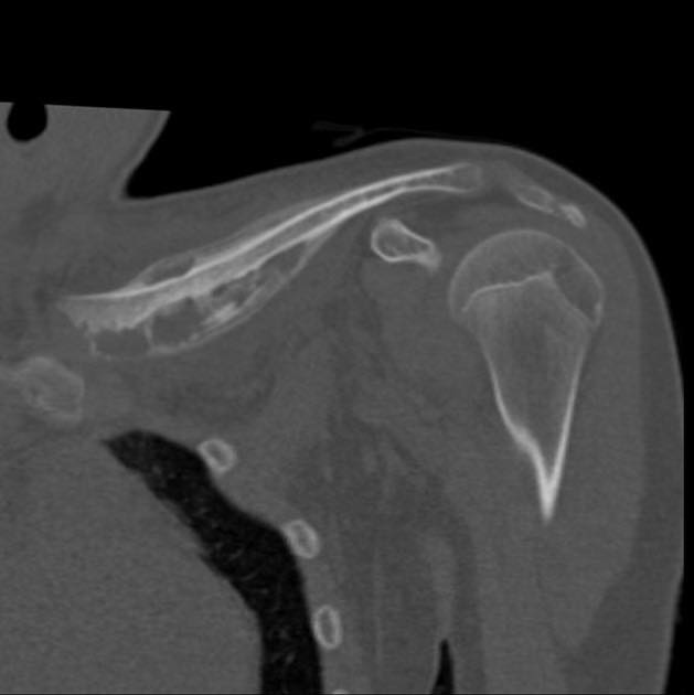 Q: 15yo girl with painful left clavicle swelling. What’s the likely diagnosis?
ANSWER: radiopaedia.org/cases/79503
#FOAMrad #FOAMed