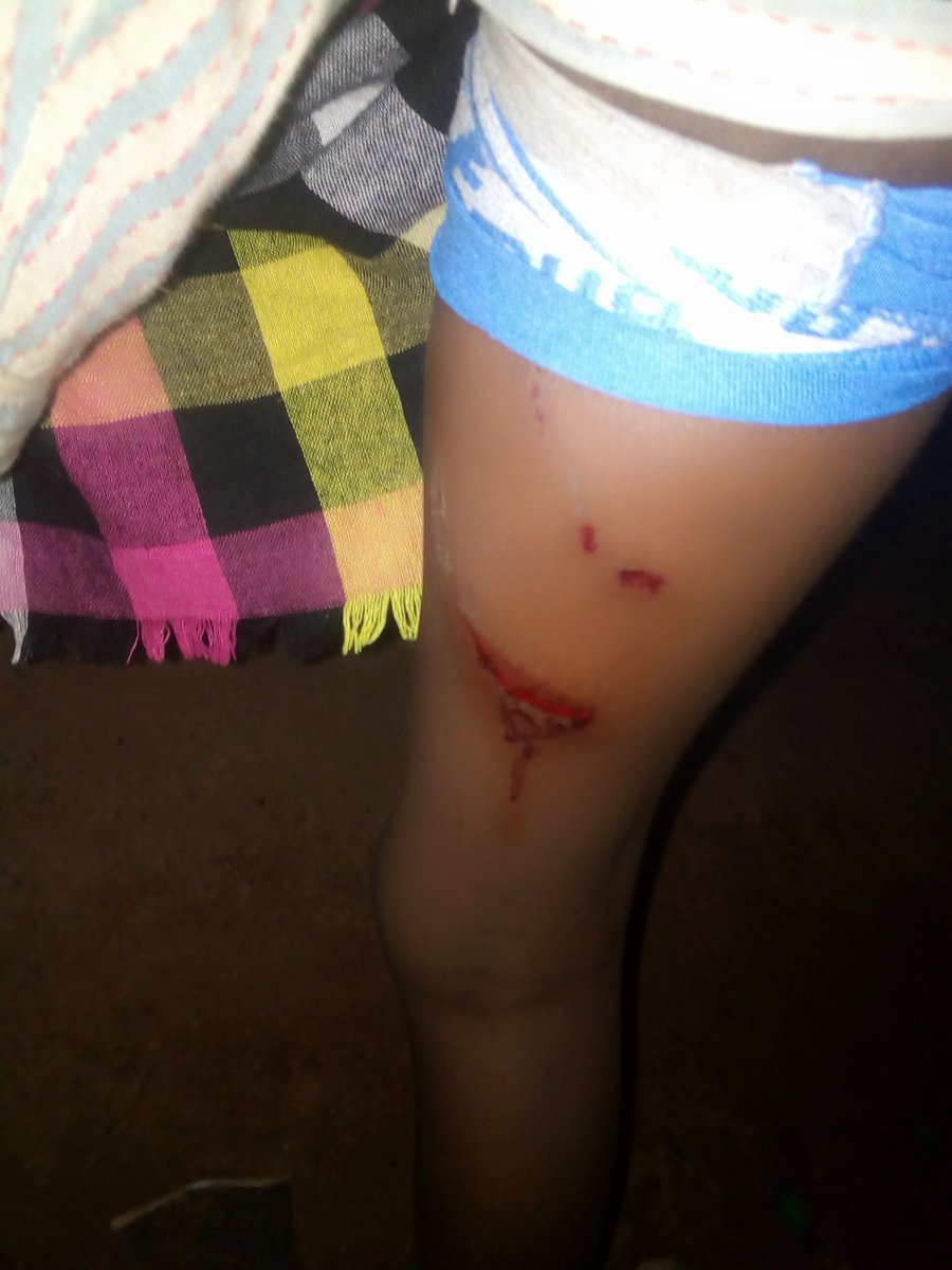 DannySecret2's tweet image. Dog bite my little sister today around 8:45pm  she currently at the hospital