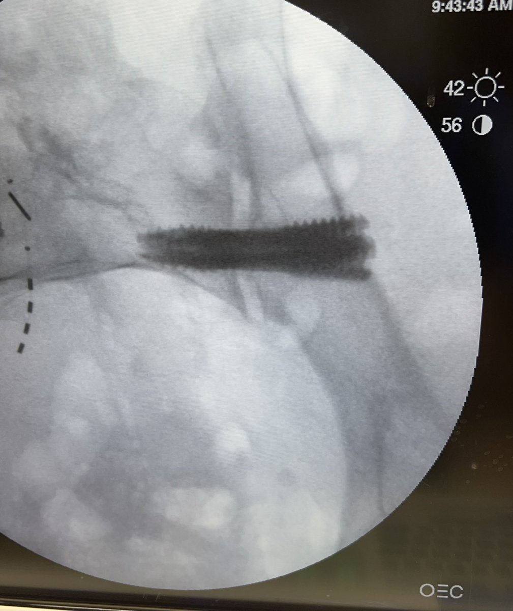 Douglas Beall (@dougbeall) on Twitter photo Lateral-based SI joint fusion in a patient with transitional lumbosacral anatomy allows for placement of larger screws especially in the S1 vertebrae. Three 10.5mm x 35, 50, & 60mm screws with plenty of room to spare <a href="/SIRspecialists/">Society of Interventional Radiology</a> <a href="/ASIPP/">ASIPP</a> <a href="/The_ASSR/">American Society of Spine Radiology (ASSR)</a> <a href="/Genesys/">Genesys</a> #sijoint Lateral-based SI joint fusion in a patient with transitional lumbosacral anatomy allows for placement of larger screws especially in the S1 vertebrae. Three 10.5mm x 35, 50, & 60mm screws with plenty of room to spare <a href="/SIRspecialists/">Society of Interventional Radiology</a> <a href="/ASIPP/">ASIPP</a> <a href="/The_ASSR/">American Society of Spine Radiology (ASSR)</a> <a href="/Genesys/">Genesys</a> #sijoint