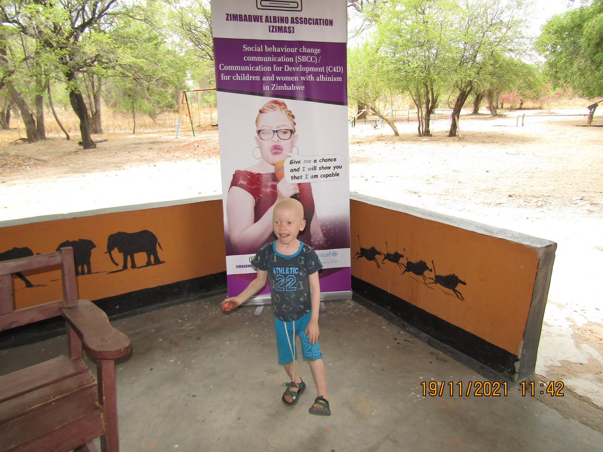 Young and confident #albinism #ForEveryChild
