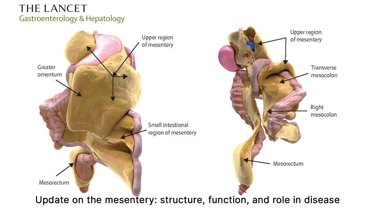 Dara Walsh (@walshdara) on Twitter photo Update on the mesenteric organ
Just published in <a href="/LancetGastroHep/">The Lancet Gastroenterology & Hepatology</a>
See link for full paper
authors.elsevier.com/a/1e7WW8nByr1F…
#some4surgery #Mesentery Update on the mesenteric organ
Just published in <a href="/LancetGastroHep/">The Lancet Gastroenterology & Hepatology</a>
See link for full paper
authors.elsevier.com/a/1e7WW8nByr1F…
#some4surgery #Mesentery