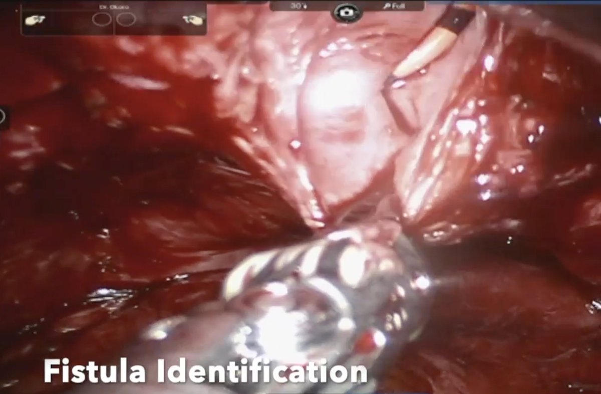 urovidjournal's tweet photo. 📺 Step-by-Step #Robotic-Assisted Vesicovaginal Fistula Repair with Omental Flap Interposition

#OpenAccess Video &amp; Article 
👇👇
https://t.co/7waQsJWPBn

Paper by @md_eun, @ChinoOkoro @TempleUrology 

Editors: @drjkaouk @lee_c_zhao  @JillC_Buckley https://t.co/1optwHFmD3