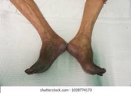 Morning Morning 🤷🏼
نقص الأكسجين الطرفي الحاد أو نقص التروية الطرفي الحاد مايعرف ب Acute limb ischaemia) هو اضطراب يحدث عند وجود نقص مفاجئ في تدفق الدم إلى الأطراف. ينتج عنه نقص الأوكسجين الطرفي الحاد🧐