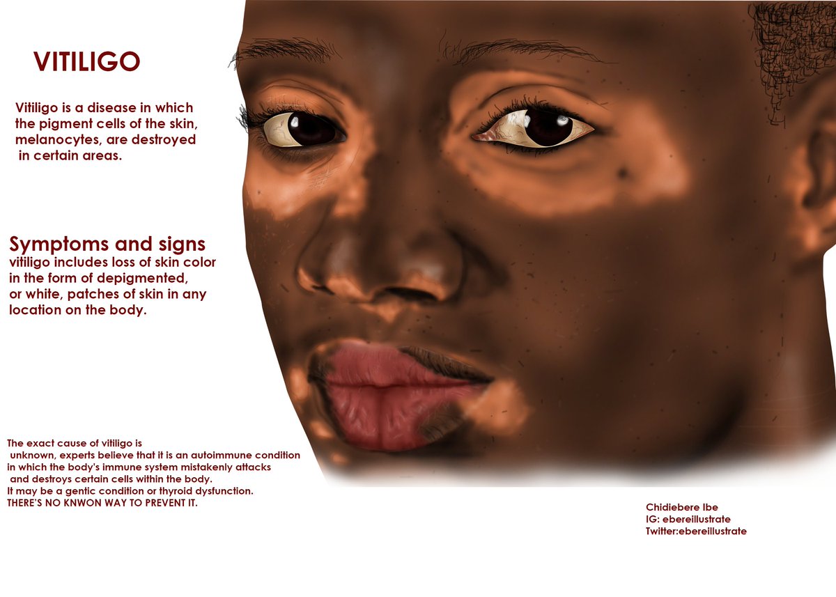 ebereillustrate's tweet photo. Vitiligo Illustration in #black #skin. How often do you see medical illustration of shades- Black Skin? Rarely! Join me to promoting this cause, by making a kind donation🙏.

https://t.co/8BEeKi8saF 

#artwork #illustration #art #ArtistOnTwitter #MedTwitter #MedEd https://t.co/hKRremo6Lq