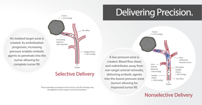 Have you heard about the latest innovation in embolization?
The Sniper balloon occlusion microcatheter enables a pressure-directed treatment solution for arterial embolizations.
#embolization #interventional #interventionaloncology 

<a href="/EmbolxInc/">Embolx</a>