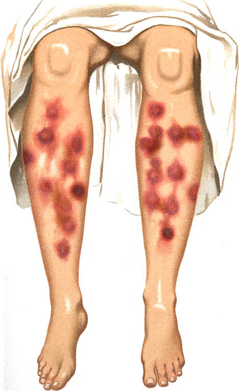 30M patient presents with red legs.

What would you be thinking? Open this thread and I'll share my approach.

#MedEd #Tweetorial
#MedTwitter #MedStudentTwitter
<a href="/MedTweetorials/">MedTweetorials</a>