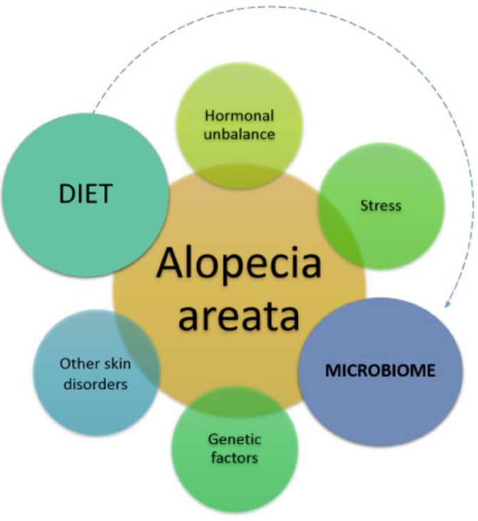 NutritionImmuno's tweet photo. Do you struggle with Alopecia? A recent study investigates the link between your hair health and the microbiome in your gut and on your skin. Could Nutritional and lifestyle support help you?
#nutrition #skin #hair #mirobiome #gut #Health #alopecia #diet

https://t.co/hpWdHwSwYA https://t.co/UuX3HXwsAa