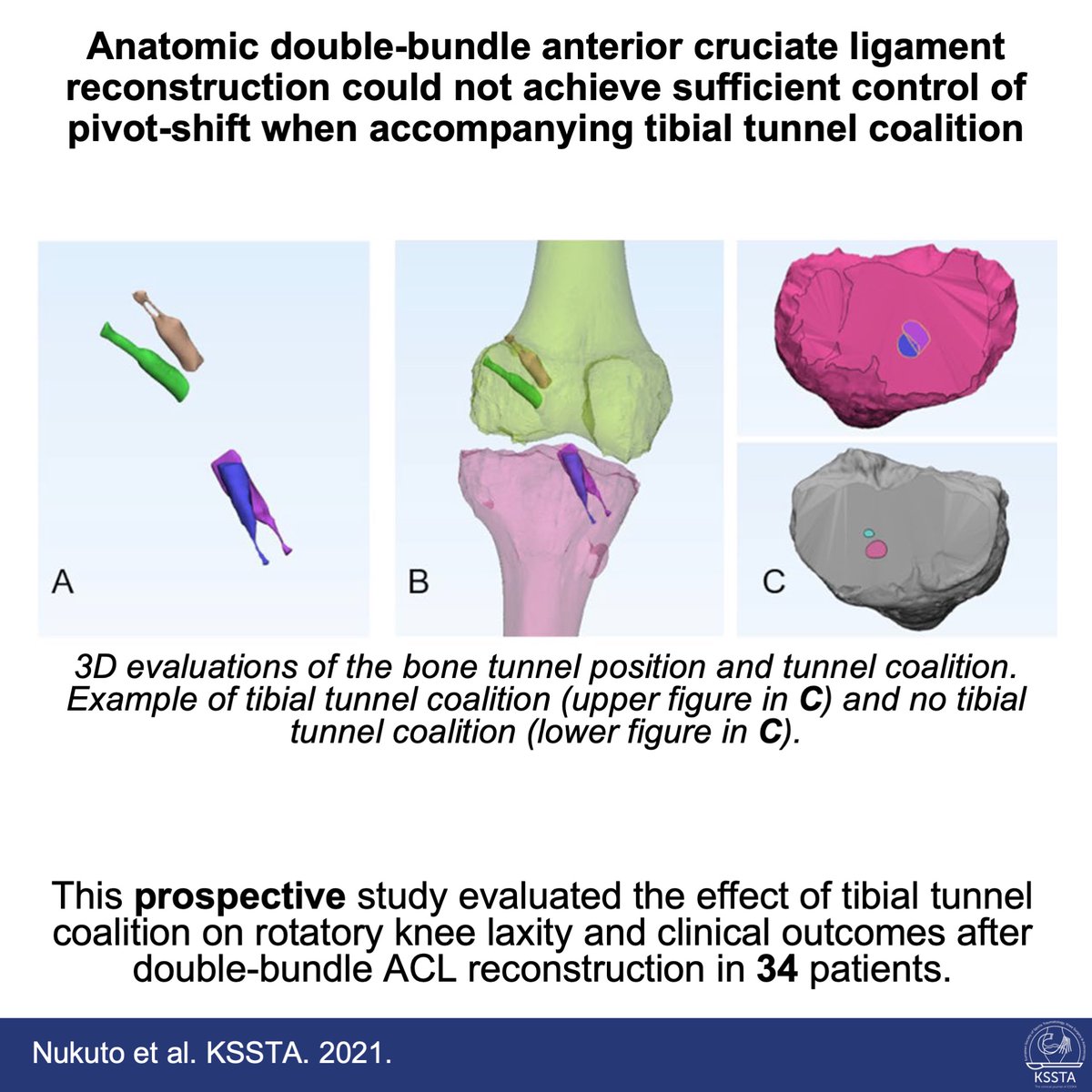 KSSTA's tweet photo. Tibial tunnel coalition should be avoided to prevent persistent rotatory knee laxity after double-bundle ACL reconstruction.
#sportstraumatology #ACL #instability #knee #arthroscopyofknee #orthopedist
Reach here: https://t.co/MzjVolKlQD https://t.co/QfybT2pAIk