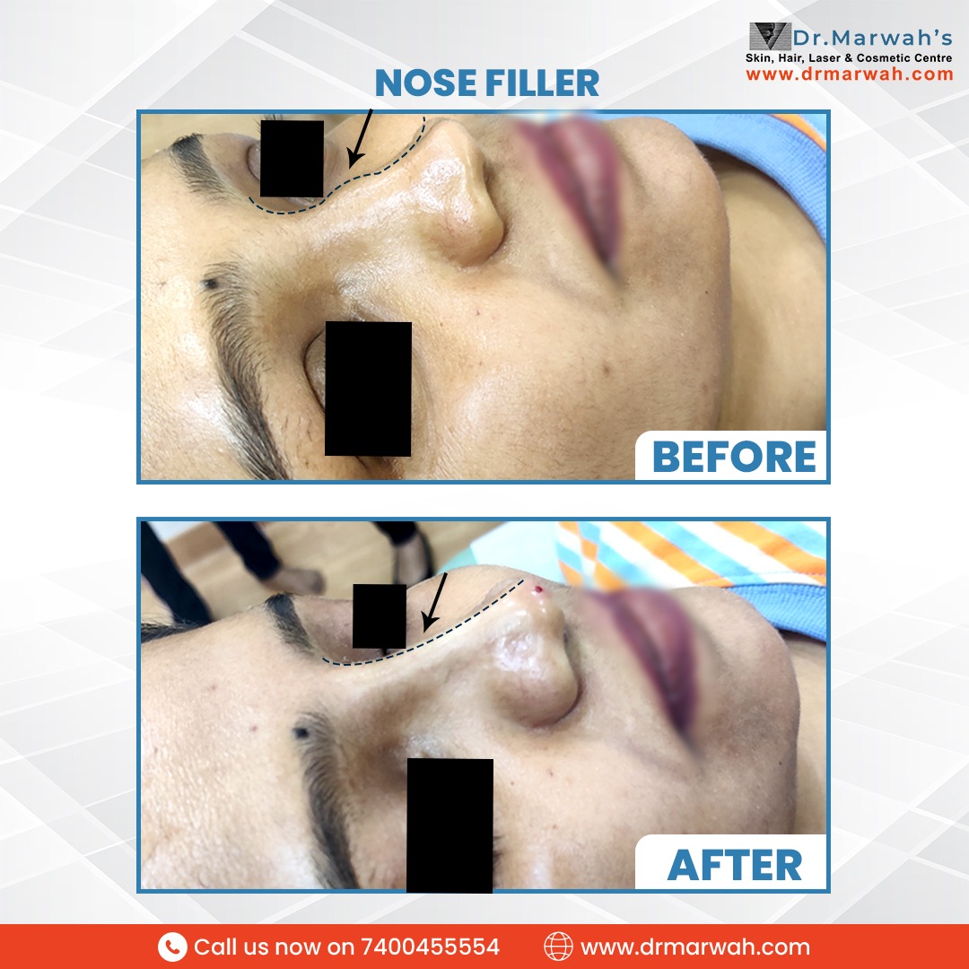 DrMarwahs's tweet photo. #Nonsurgicalrhinoplasty, is a minimally invasive method of #nosecorrection that does not require surgical intervention. The patient can resume his or her normal lifestyle immediately after the procedure.
For more information or to book an appointment, you can call on 7400455554 https://t.co/pkC2E42rhN