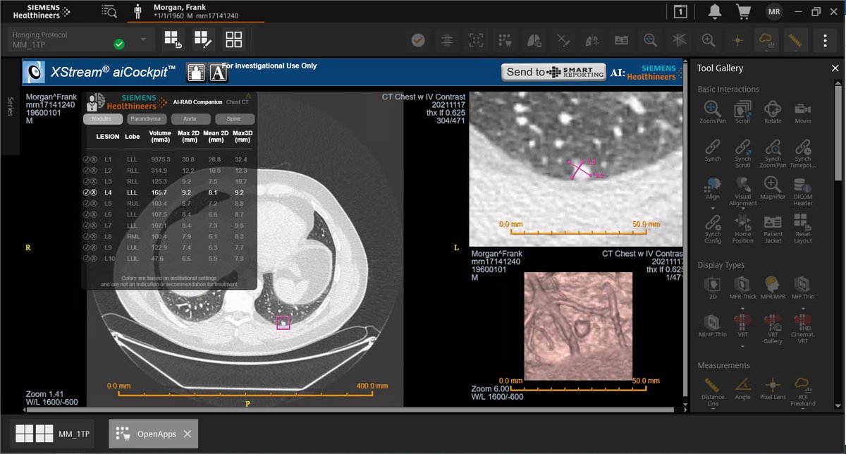 TeriMSippel's tweet photo. Visit @SiemensHealth in the RSNA Imaging AI in Practice Demo to see AI quantify lung nodules and other findings on a CT Chest and watch those coded and structured results flow from the PACS to the radiology report. South Hall 4925 #RSNA21 #RadLex #CDE #RadAI #ImagingAI #radlex https://t.co/Wvyn8lsfBn