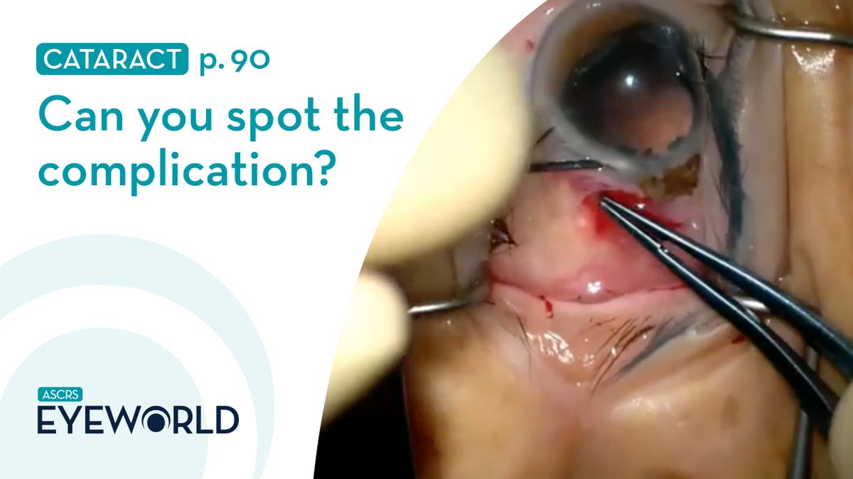 ASCRStweets's tweet photo. Can you spot the complication?
Yes, it’s iris prolapse. Naveen Rao, MD, takes readers through a case, and Michael Snyder, MD, offers pearls for avoiding and managing it https://t.co/5rpKPclL3T
#EyeWorldMagazine #ophthalmology #cataractsurgery #complicatedcases https://t.co/1IumlxKEIJ