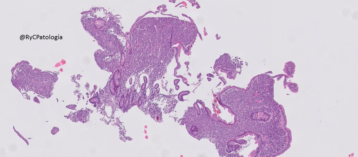 RyCPatologia's tweet photo. ➡️ Paciente con VIH.
➡️ Duodeno con imagen endoscópica de atrofia vellositaria.
🔬 Inmunohistoquímica: CD1a de Leica.

☑️ Leishmaniasis intestinal.
#RyCPath #GIPath #BugPath https://t.co/QrQiG8ELKC