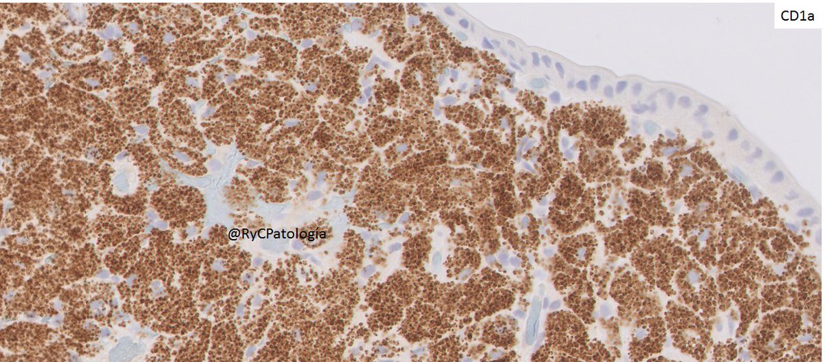 RyCPatologia's tweet photo. ➡️ Paciente con VIH.
➡️ Duodeno con imagen endoscópica de atrofia vellositaria.
🔬 Inmunohistoquímica: CD1a de Leica.

☑️ Leishmaniasis intestinal.
#RyCPath #GIPath #BugPath https://t.co/QrQiG8ELKC