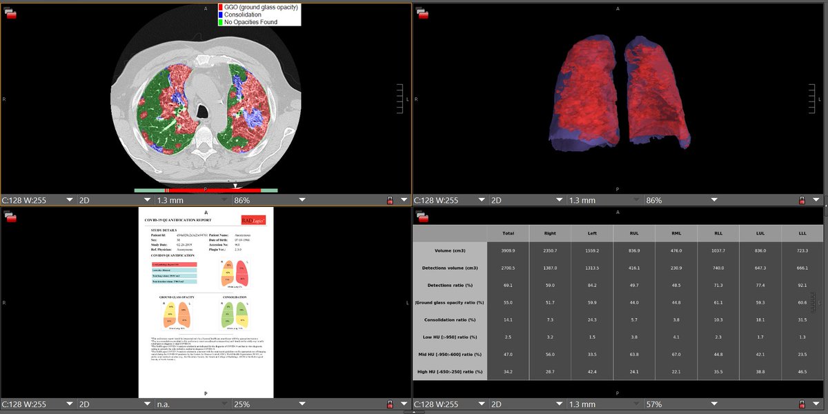 TeriMSippel's tweet photo. Visit @radlogics in the RSNA Imaging AI in Practice Demo to see AI quantify lung nodules and other findings on a CT Chest and watch those coded and structured results flow to the radiology report. Tedious task done. South Hall 4925 #RSNA21 #RadLex #CDE #RadAI #ImagingAI @RSNA https://t.co/OgzdRwfBRb