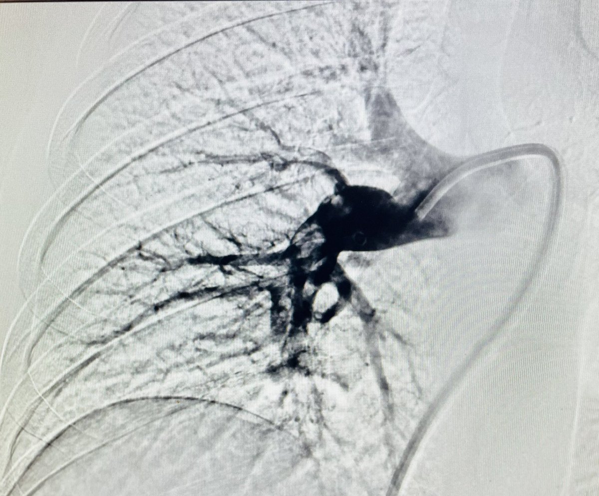 Robert A Lookstein MD, MHCDL (@roblookstein) on Twitter photo Live <a href="/MountSinaiIR/">Mount Sinai IR</a> #PERT is busy here at <a href="/MountSinaiNYC/">Mount Sinai Health System</a> using all available USFDA approved technologies to provide excellent pt care <a href="/PERTConsortium/">The PERT Consortium®</a> <a href="/SIRspecialists/">Society of Interventional Radiology</a> Live <a href="/MountSinaiIR/">Mount Sinai IR</a> #PERT is busy here at <a href="/MountSinaiNYC/">Mount Sinai Health System</a> using all available USFDA approved technologies to provide excellent pt care <a href="/PERTConsortium/">The PERT Consortium®</a> <a href="/SIRspecialists/">Society of Interventional Radiology</a>