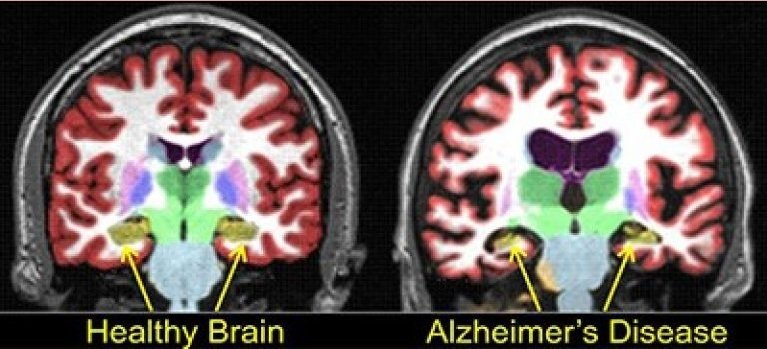 Мозг альцгеймер мрт. Мрт диагностика болезни альцгеймера. Кт при болезни альцгеймера. Деменция мрт снимок. Мрт головного мозга при болезни альцгеймера.