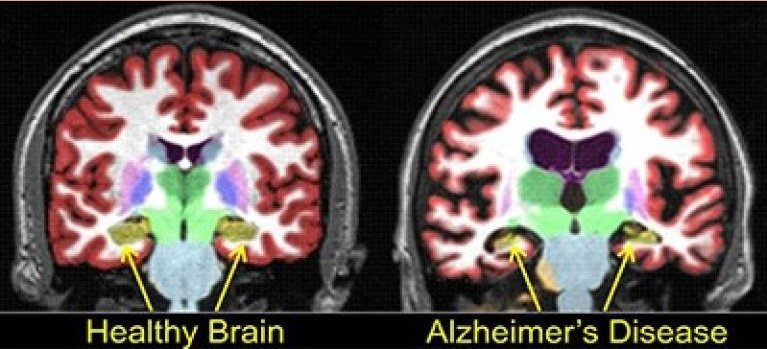 Болезни связанные с мозгом. Мрт головного мозга при болезни Альцгеймера. Болезнь Альцгеймера на кт головного мозга. Болезнь Альцгеймера кт и мрт. Болезнь Альцгеймера снимки мрт.