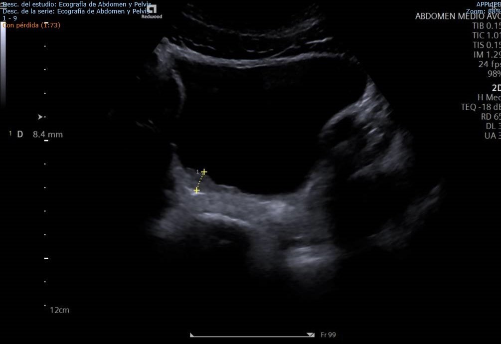 🚨 Tenemos nuevo caso!

🌍 Varón 18 años, natural de Mauritania. En España desde hace 8 meses. 
🩸 Derivado de AP por eosinofilia (Eo absolutos 580/microL).
👨🏻‍⚕️ Historiando nos cuenta hematuria terminal. 
📸 Se realiza eco abdominal en acto único con la siguiente lesión…