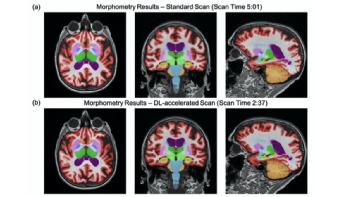 SubtleMedical's tweet image. Join Dr. @suzie_bash at @RSNA in our AI Theatre presentation as she discusses the clinical validation of #SubtleMR &amp;amp; #Neuroquant - 60% Accelerated Volumetric Brain MRI While Preserving Quantitative Performance.

Register &amp;amp; add to your calendar here: bit.ly/RSNARSVP