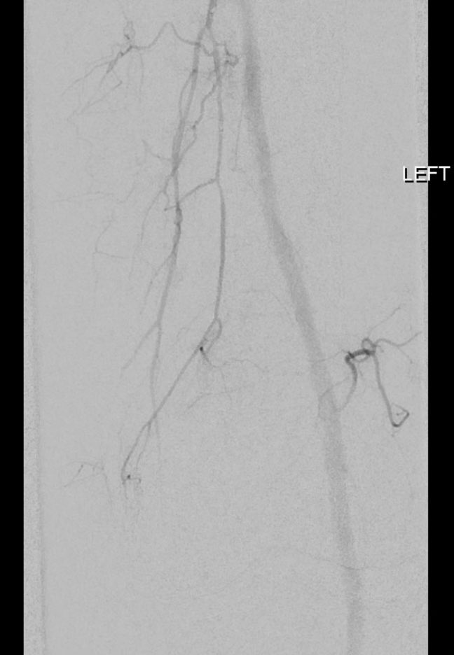 MGHIR (@mghir1) on Twitter photo Thrilled this MGH #irad team here lead by <a href="/DaniaDaye/">Dania Daye, MD PhD</a> was able to help this pt struggling w/severe arthritis with genicular artery embolization #GAE <a href="/maritanaka808/">Mari Tassarotti, MD</a> <a href="/robsheridanavir/">Rob Sheridan</a> <a href="/MGHImaging/">Mass General Imaging</a> #HappyThanksgiving Thrilled this MGH #irad team here lead by <a href="/DaniaDaye/">Dania Daye, MD PhD</a> was able to help this pt struggling w/severe arthritis with genicular artery embolization #GAE <a href="/maritanaka808/">Mari Tassarotti, MD</a> <a href="/robsheridanavir/">Rob Sheridan</a> <a href="/MGHImaging/">Mass General Imaging</a> #HappyThanksgiving