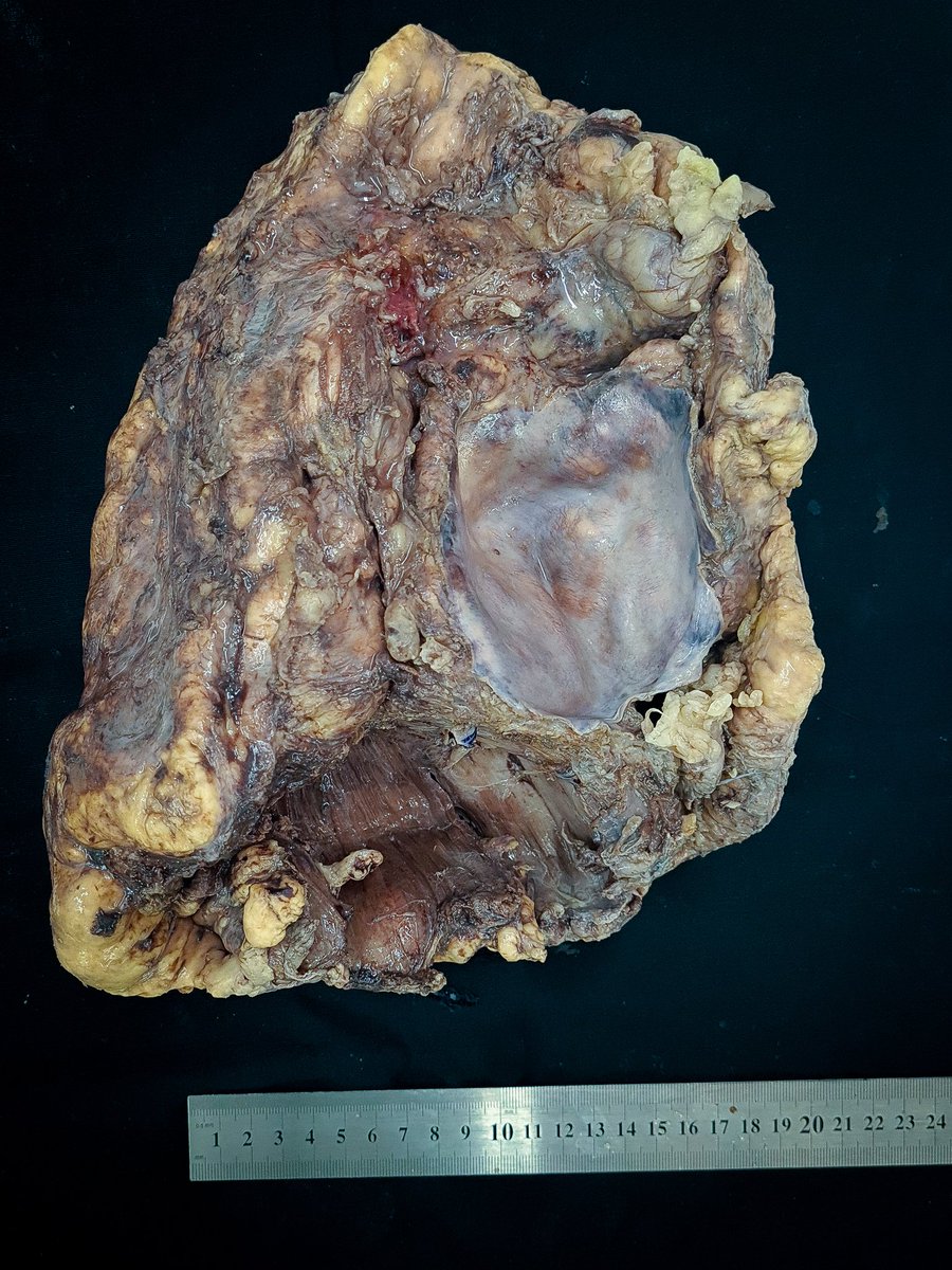 fabiotavora's tweet photo. What we do for a good #grossphoto #PathTwitter #thoracicpathology rare case of mesothelioma in Northeastern Brazil @AndreMo77438628 @smlungpathguy @ArgosPatologia #iamapathologist https://t.co/dD8SZjp25n