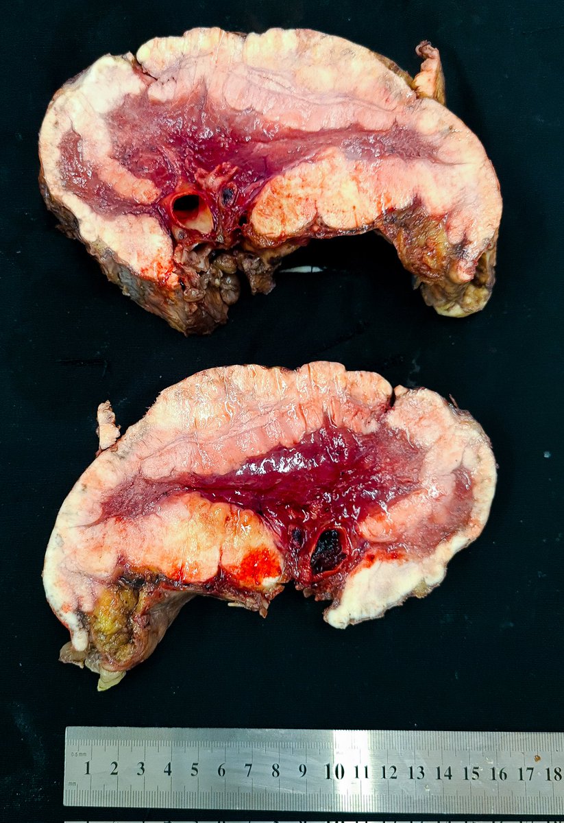 fabiotavora's tweet photo. What we do for a good #grossphoto #PathTwitter #thoracicpathology rare case of mesothelioma in Northeastern Brazil @AndreMo77438628 @smlungpathguy @ArgosPatologia #iamapathologist https://t.co/dD8SZjp25n