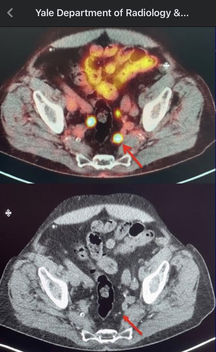 YaleRadiology's tweet photo. Pylarify (18F-DCFPyL) was recently FDA-approved for prostate cancer imaging. @YaleRadiology was part of 2 multi-center clinical trials, enrolling the first patients in the nation. #FightProstateCancer
💪
https://t.co/grtPxDEkqj
🧔🏿🧔🏾🧔🏽🧔🏼🧔🏻🧔👨🏿👨🏾👨🏽👨🏼👨🏻👨
#Movember #MensHealth https://t.co/vEoXjPWG2j