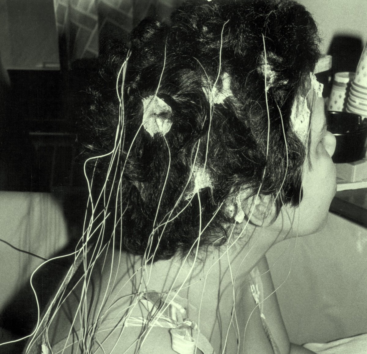 RushArchives (@rusharchives) on Twitter photo #EpilepsyAwarenessMonth <a href="/RushMedical/">Rush University System for Health</a> opened new Epilepsy Treatment Ctr, 1985, w/room w/ video & EEG for brain wave monitoring. Patient could wear monitors for many days. Info helped staff decide how to proceed: bit.ly/3tWHBH8 (Virginia Hall, EEG tech) <a href="/RushUniversity/">Rush University</a> #EpilepsyAwarenessMonth <a href="/RushMedical/">Rush University System for Health</a> opened new Epilepsy Treatment Ctr, 1985, w/room w/ video & EEG for brain wave monitoring. Patient could wear monitors for many days. Info helped staff decide how to proceed: bit.ly/3tWHBH8 (Virginia Hall, EEG tech) <a href="/RushUniversity/">Rush University</a>