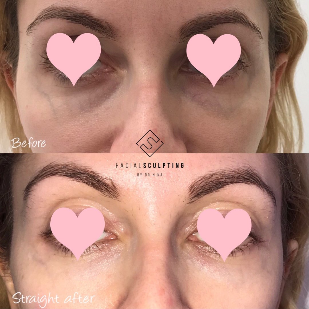 DrNinaBal's tweet photo. Wipe away 10 even 15 years from your face in just 30 minutes. Is it magic? No, it's one of the "WOW treatments" that almost instantly changes your face and overall appearance. 
Find out everything about this procedure on my latest IG post! https://t.co/K7690AuCpI