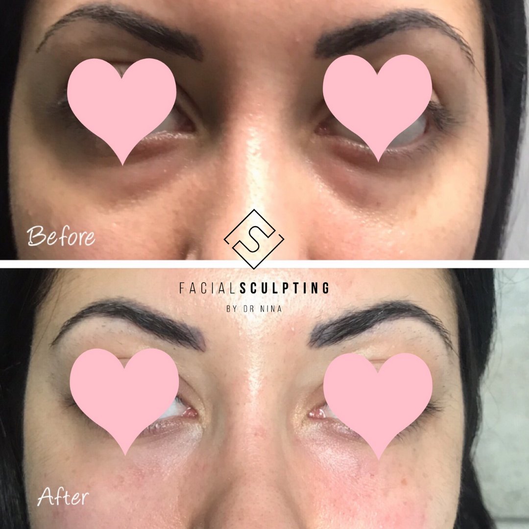 DrNinaBal's tweet photo. Wipe away 10 even 15 years from your face in just 30 minutes. Is it magic? No, it's one of the "WOW treatments" that almost instantly changes your face and overall appearance. 
Find out everything about this procedure on my latest IG post! https://t.co/K7690AuCpI