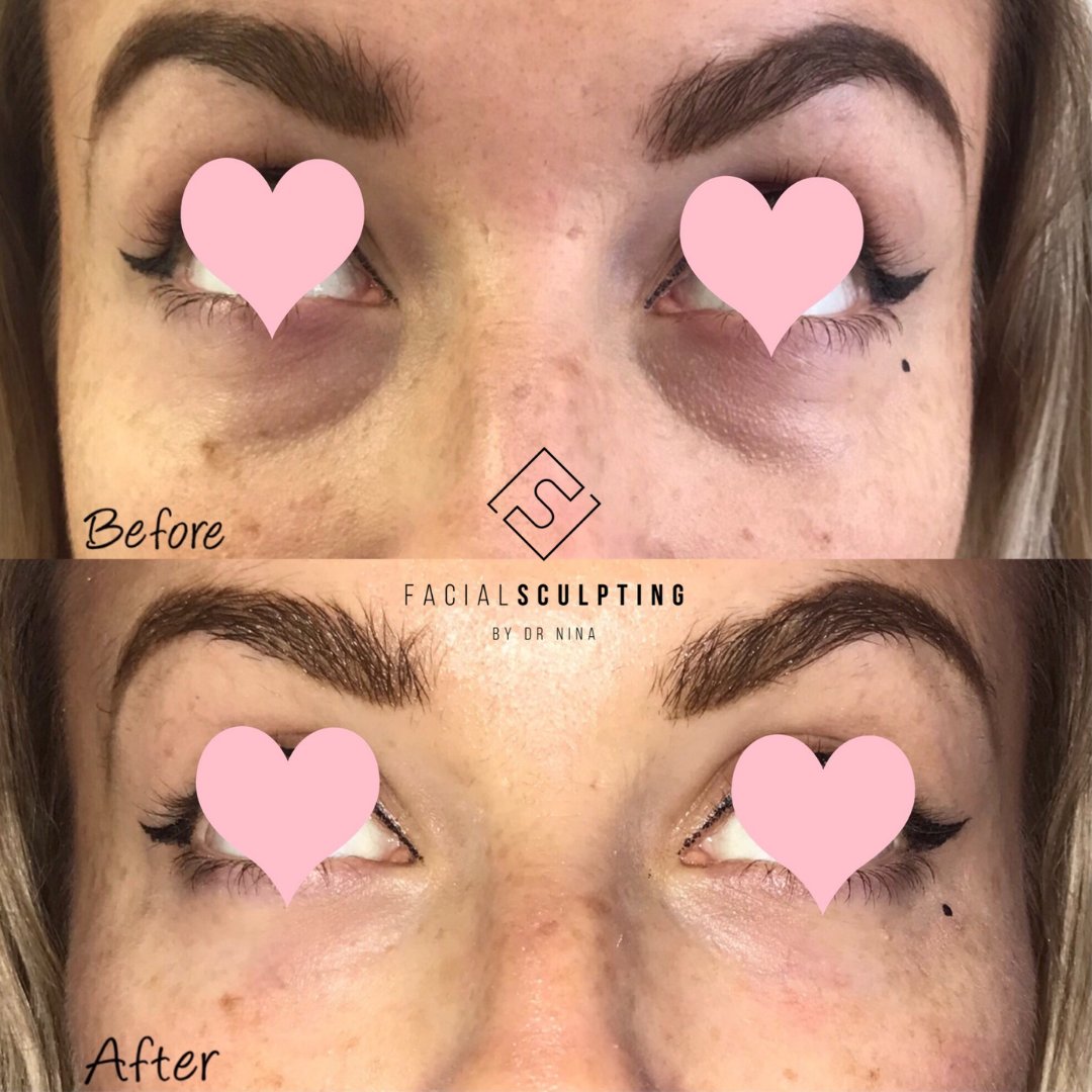 DrNinaBal's tweet photo. Wipe away 10 even 15 years from your face in just 30 minutes. Is it magic? No, it's one of the "WOW treatments" that almost instantly changes your face and overall appearance. 
Find out everything about this procedure on my latest IG post! https://t.co/K7690AuCpI